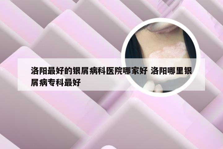 洛阳最好的银屑病科医院哪家好 洛阳哪里银屑病专科最好