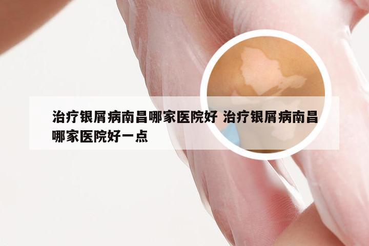 治疗银屑病南昌哪家医院好 治疗银屑病南昌哪家医院好一点