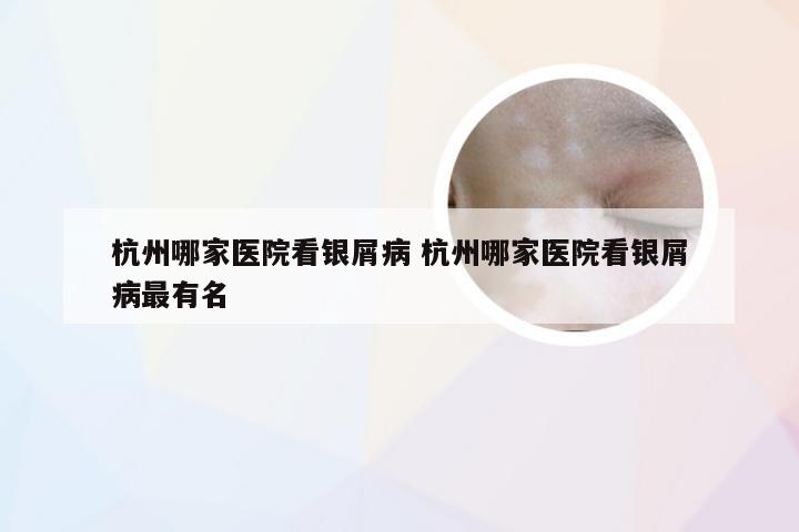 杭州哪家医院看银屑病 杭州哪家医院看银屑病最有名