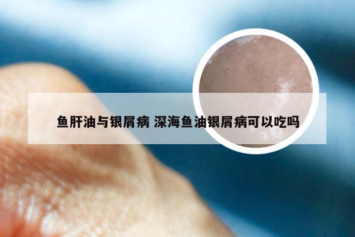 鱼肝油与银屑病 深海鱼油银屑病可以吃吗