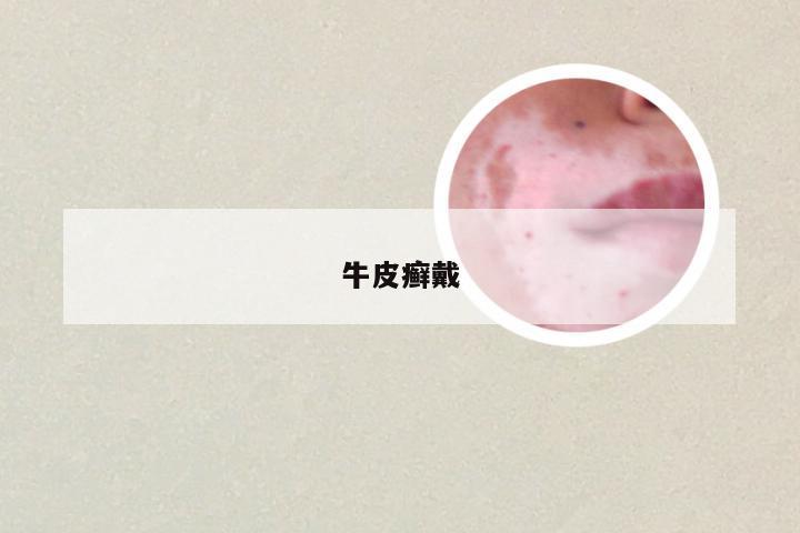 牛皮癣戴