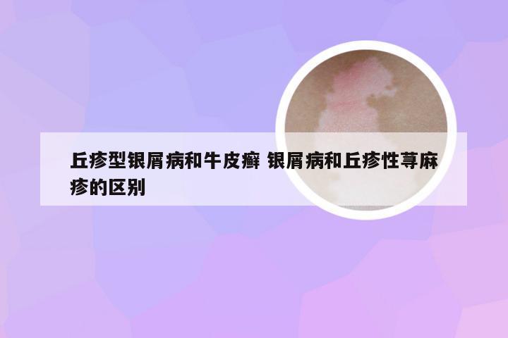 丘疹型银屑病和牛皮癣 银屑病和丘疹性荨麻疹的区别