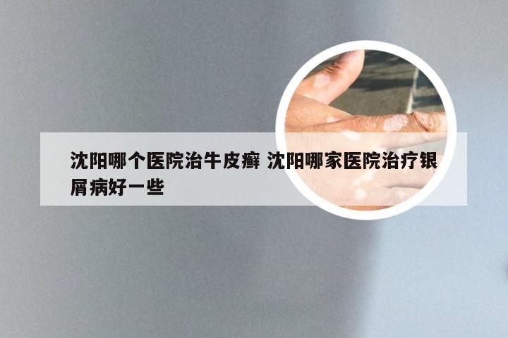 沈阳哪个医院治牛皮癣 沈阳哪家医院治疗银屑病好一些