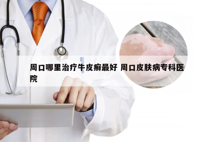 周口哪里治疗牛皮癣最好 周口皮肤病专科医院