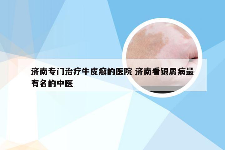 济南专门治疗牛皮癣的医院 济南看银屑病最有名的中医