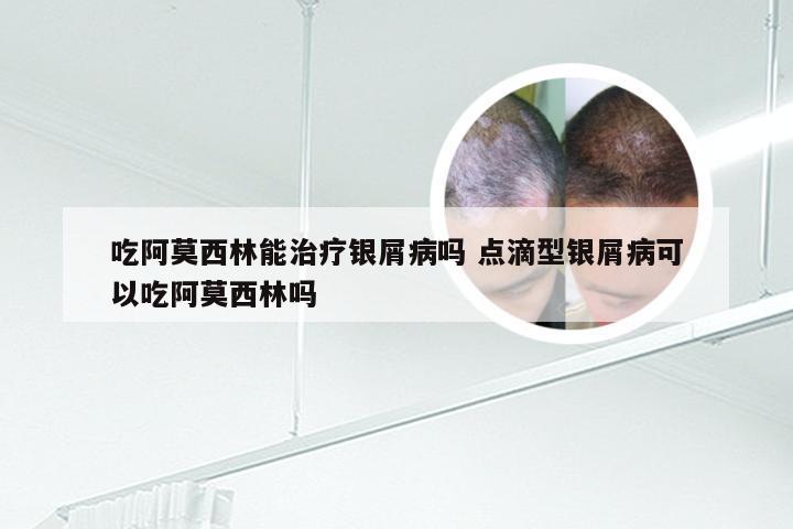吃阿莫西林能治疗银屑病吗 点滴型银屑病可以吃阿莫西林吗
