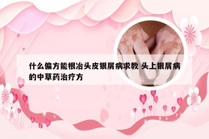 什么偏方能根冶头皮银屑病求教 头上银屑病的中草药治疗方