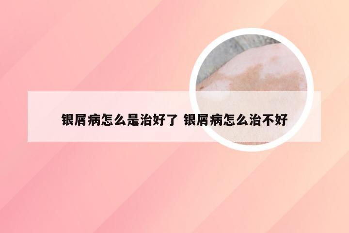 银屑病怎么是治好了 银屑病怎么治不好