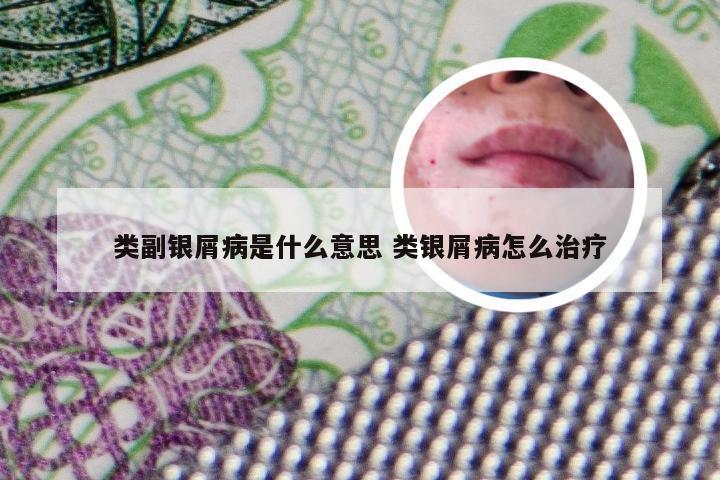 类副银屑病是什么意思 类银屑病怎么治疗