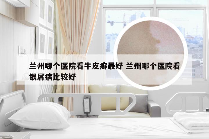 兰州哪个医院看牛皮癣最好 兰州哪个医院看银屑病比较好