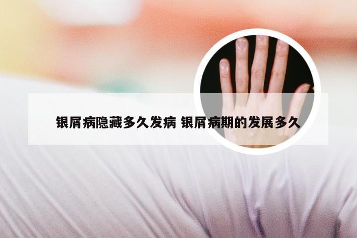 银屑病隐藏多久发病 银屑病期的发展多久