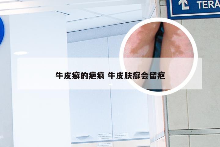 牛皮癣的疤痕 牛皮肤癣会留疤