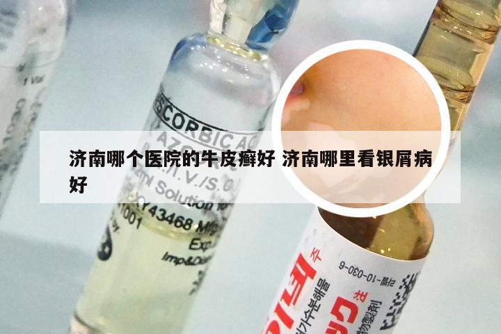 济南哪个医院的牛皮癣好 济南哪里看银屑病好