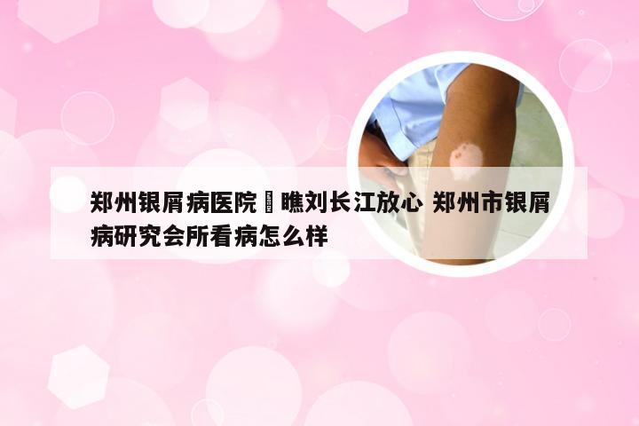 郑州银屑病医院來瞧刘长江放心 郑州市银屑病研究会所看病怎么样