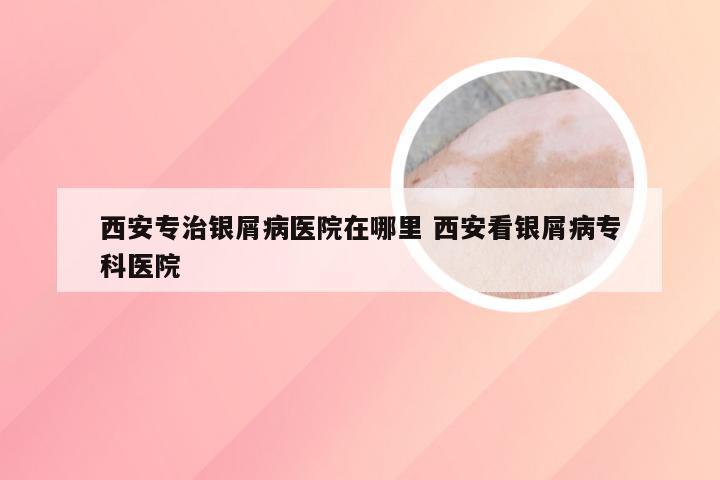 西安专治银屑病医院在哪里 西安看银屑病专科医院