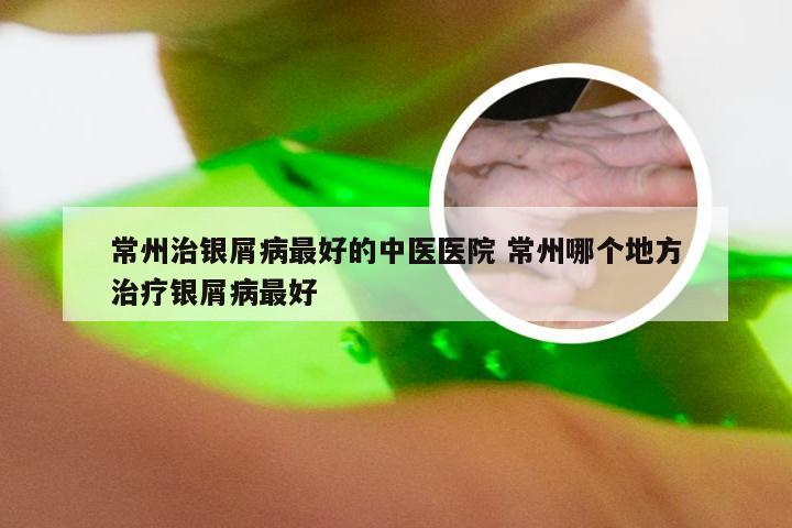 常州治银屑病最好的中医医院 常州哪个地方治疗银屑病最好