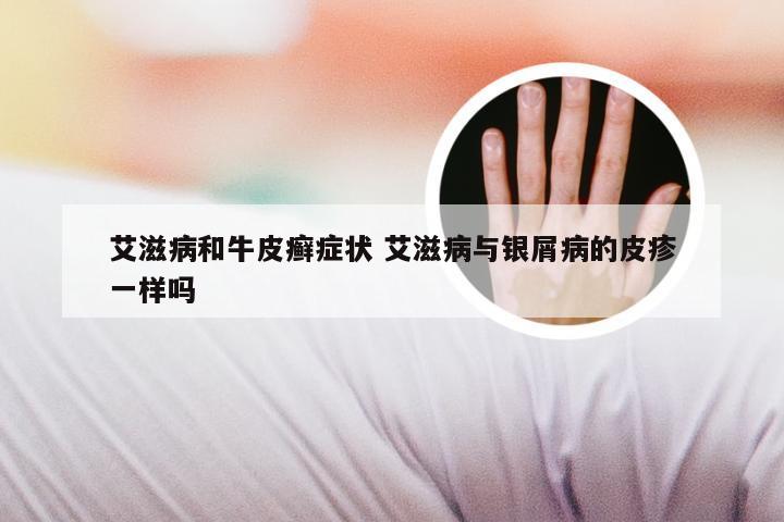 艾滋病和牛皮癣症状 艾滋病与银屑病的皮疹一样吗
