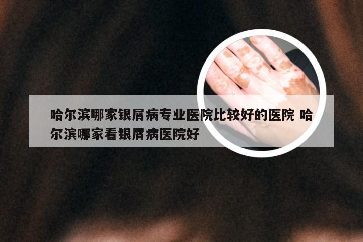 哈尔滨哪家银屑病专业医院比较好的医院 哈尔滨哪家看银屑病医院好