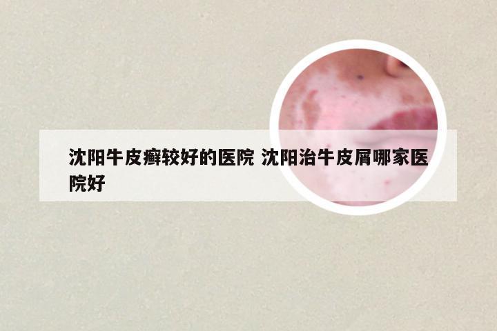 沈阳牛皮癣较好的医院 沈阳治牛皮屑哪家医院好