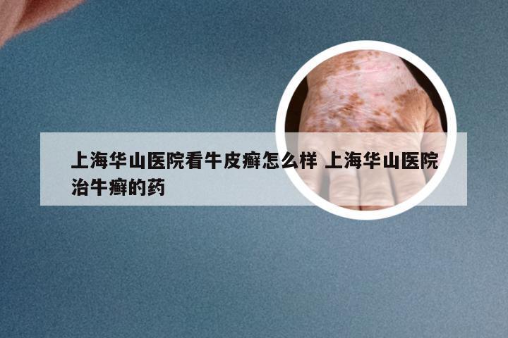 上海华山医院看牛皮癣怎么样 上海华山医院治牛癣的药