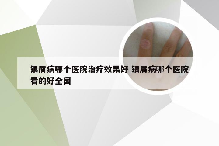 银屑病哪个医院治疗效果好 银屑病哪个医院看的好全国