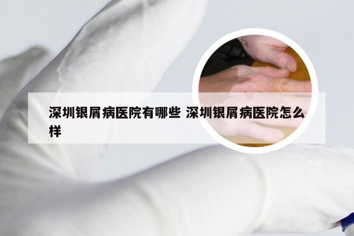 深圳银屑病医院有哪些 深圳银屑病医院怎么样