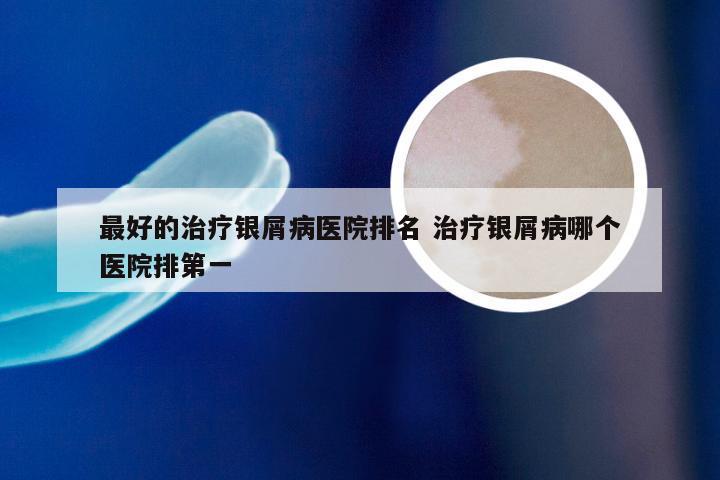 最好的治疗银屑病医院排名 治疗银屑病哪个医院排第一