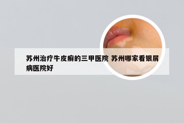苏州治疗牛皮癣的三甲医院 苏州哪家看银屑病医院好