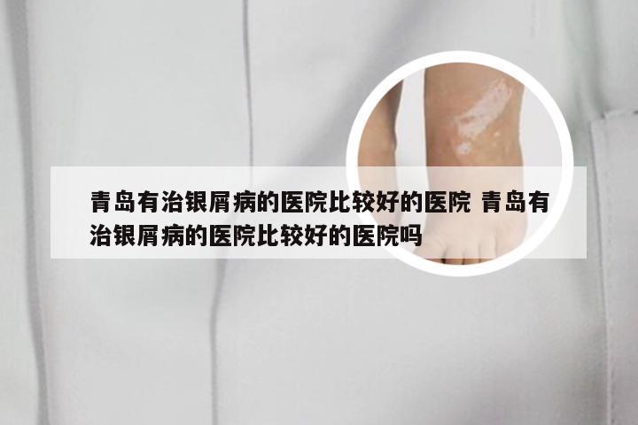 青岛有治银屑病的医院比较好的医院 青岛有治银屑病的医院比较好的医院吗