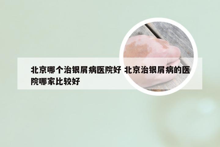 北京哪个治银屑病医院好 北京治银屑病的医院哪家比较好