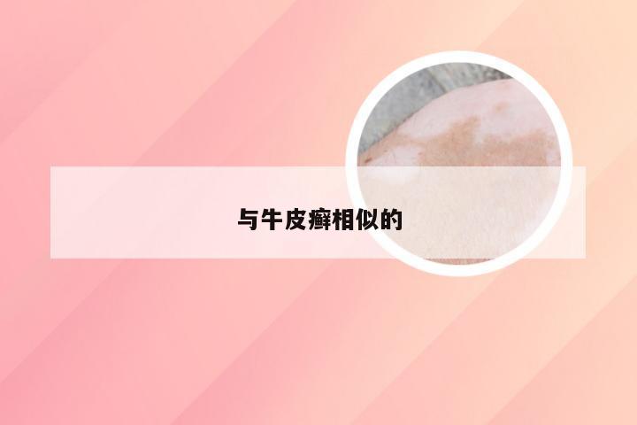与牛皮癣相似的