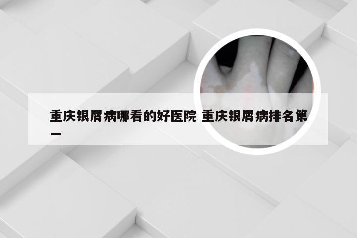 重庆银屑病哪看的好医院 重庆银屑病排名第一