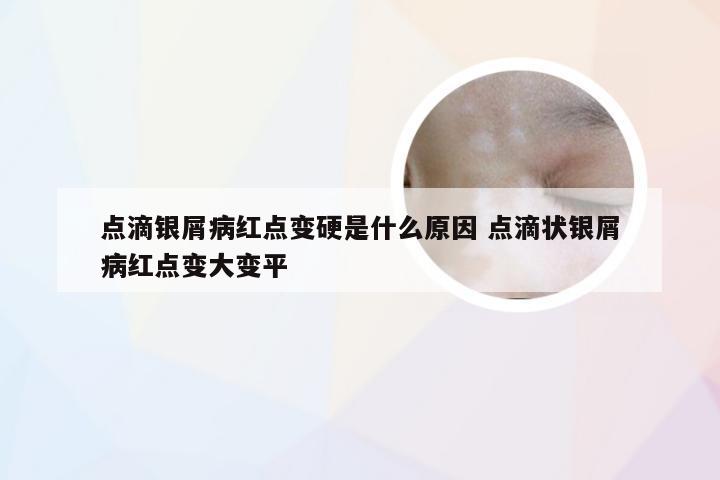 点滴银屑病红点变硬是什么原因 点滴状银屑病红点变大变平