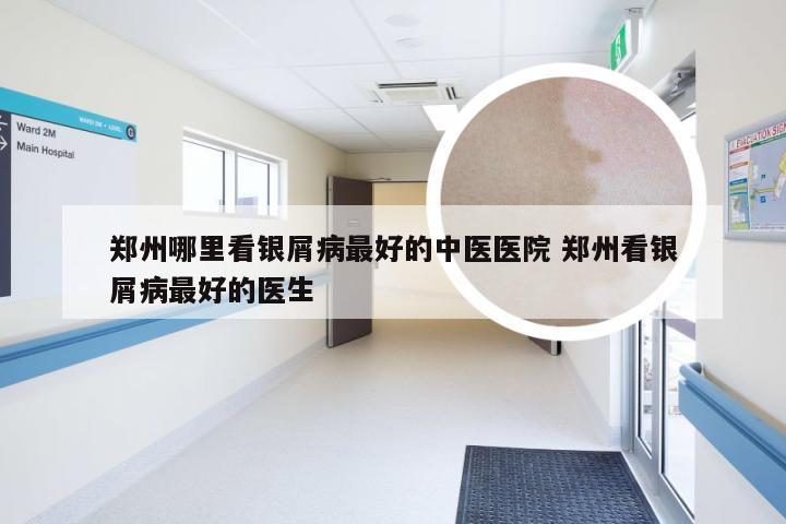 郑州哪里看银屑病最好的中医医院 郑州看银屑病最好的医生