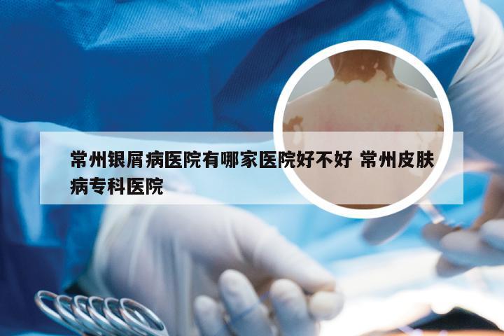 常州银屑病医院有哪家医院好不好 常州皮肤病专科医院