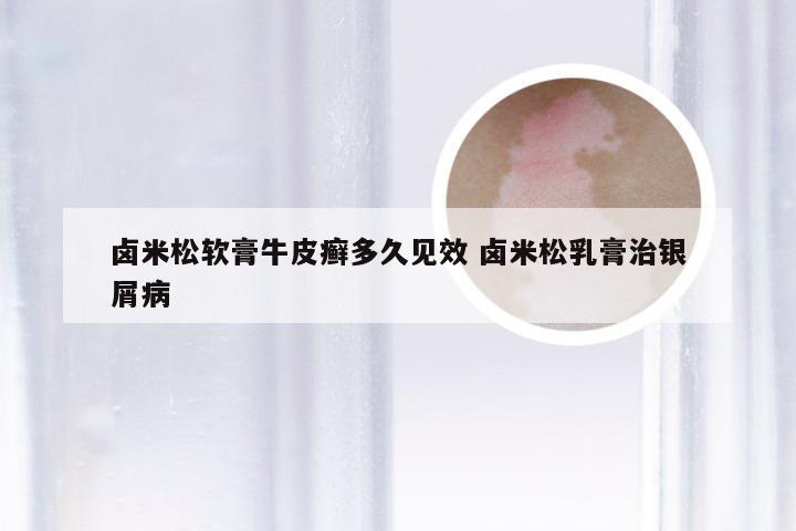 卤米松软膏牛皮癣多久见效 卤米松乳膏治银屑病