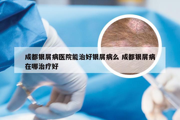 成都银屑病医院能治好银屑病么 成都银屑病在哪治疗好