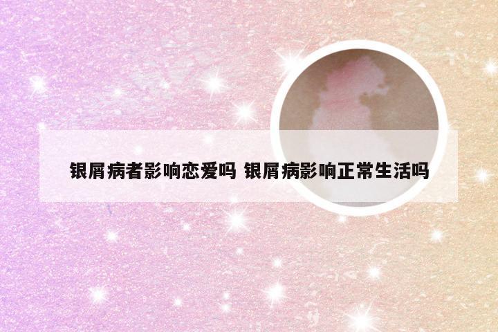 银屑病者影响恋爱吗 银屑病影响正常生活吗