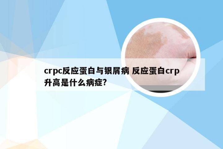 crpc反应蛋白与银屑病 反应蛋白crp升高是什么病症?
