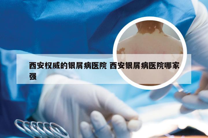 西安权威的银屑病医院 西安银屑病医院哪家强