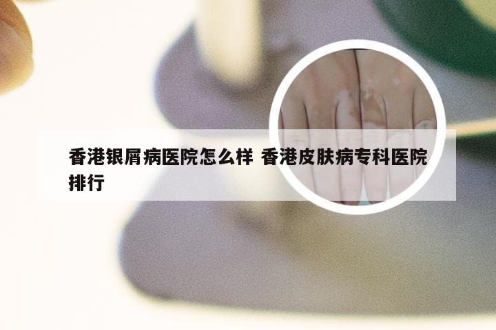 香港银屑病医院怎么样 香港皮肤病专科医院排行