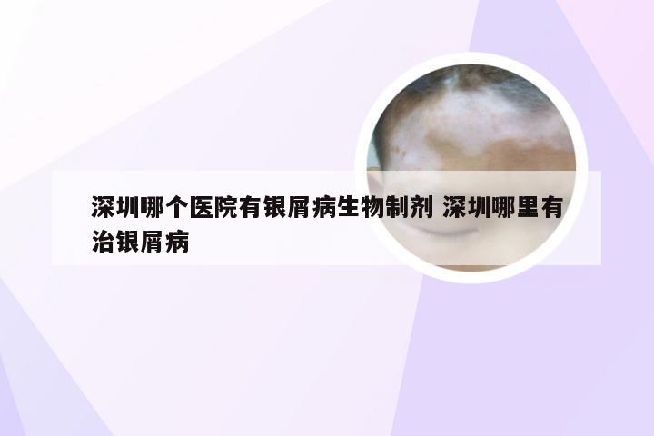 深圳哪个医院有银屑病生物制剂 深圳哪里有治银屑病