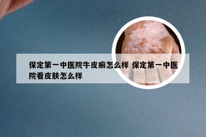 保定第一中医院牛皮癣怎么样 保定第一中医院看皮肤怎么样