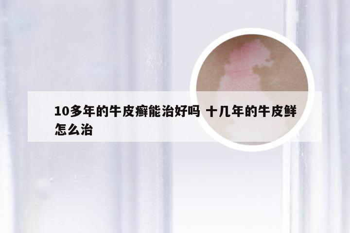 10多年的牛皮癣能治好吗 十几年的牛皮鲜怎么治