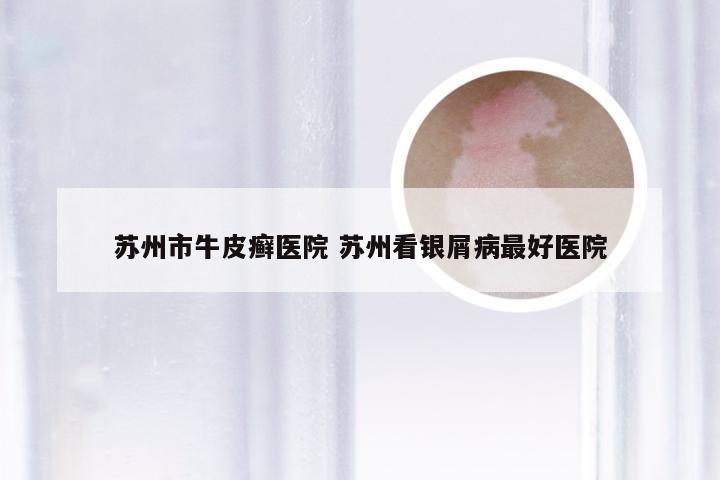 苏州市牛皮癣医院 苏州看银屑病最好医院