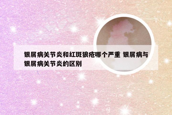 银屑病关节炎和红斑狼疮哪个严重 银屑病与银屑病关节炎的区别
