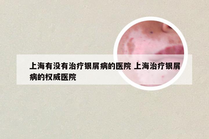 上海有没有治疗银屑病的医院 上海治疗银屑病的权威医院