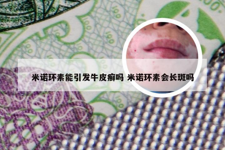 米诺环素能引发牛皮癣吗 米诺环素会长斑吗