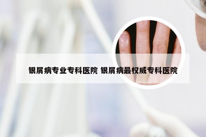 银屑病专业专科医院 银屑病最权威专科医院