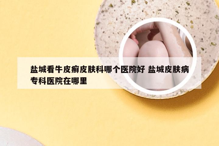 盐城看牛皮癣皮肤科哪个医院好 盐城皮肤病专科医院在哪里
